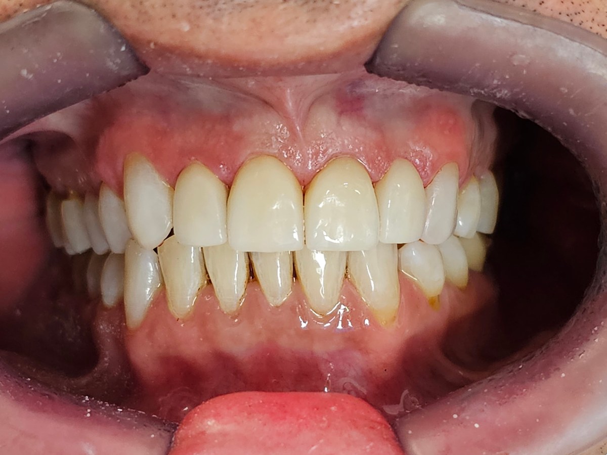 Depois do tratamento: Lentes de contato para um sorriso mais claro e harmônico