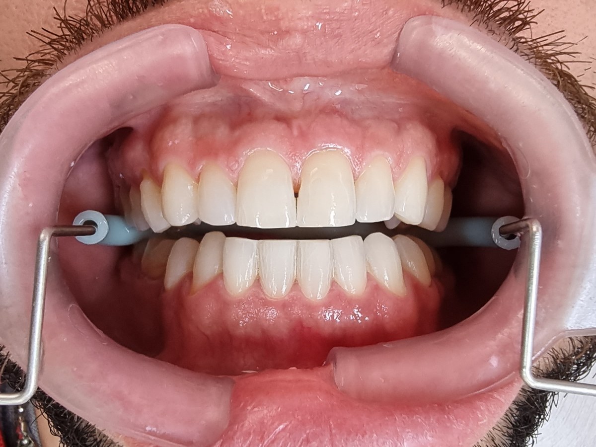 Depois do tratamento: Clareamento para um sorriso mais luminoso
