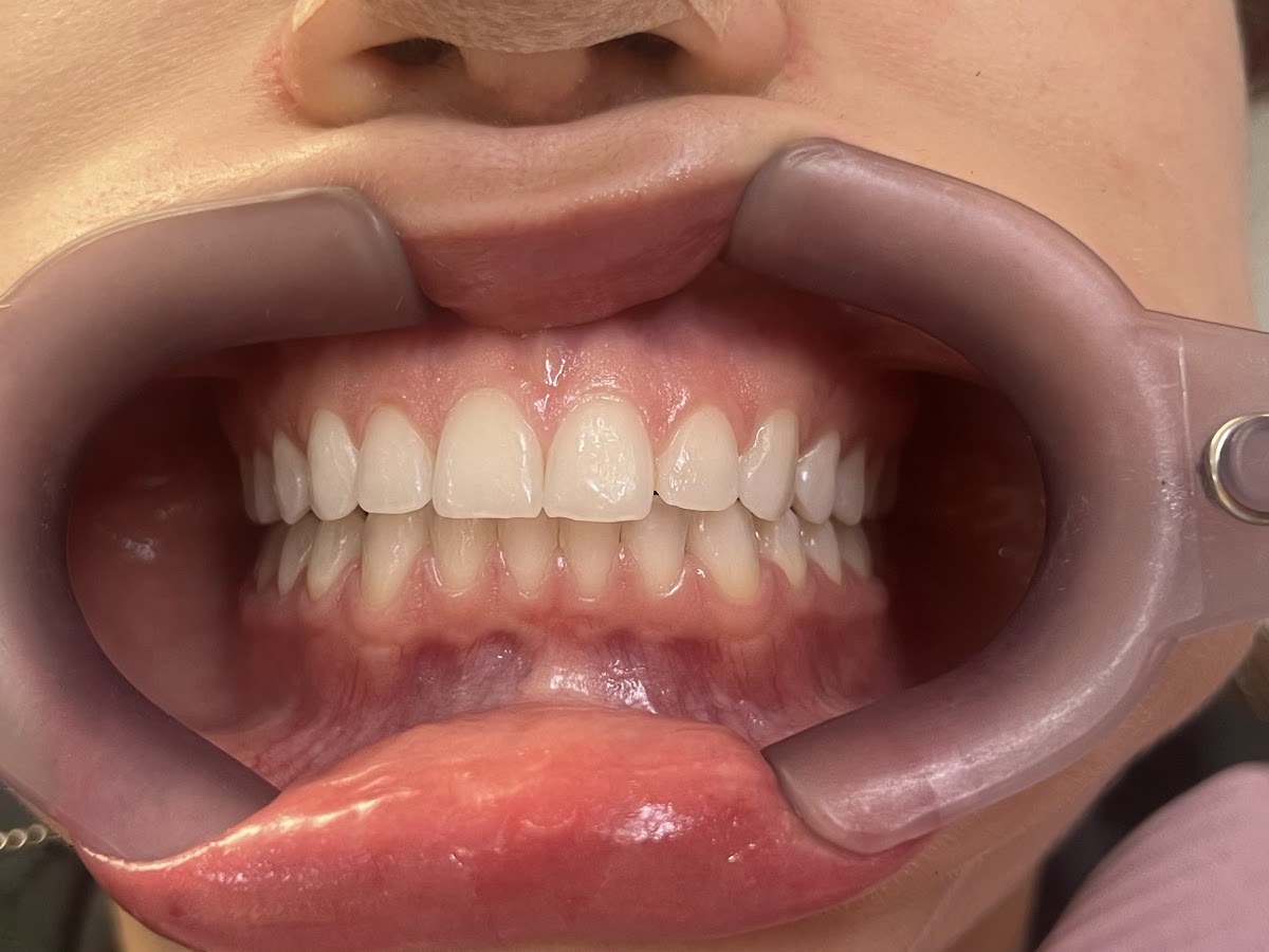 Antes do tratamento: Clareamento dental com acompanhamento clínico