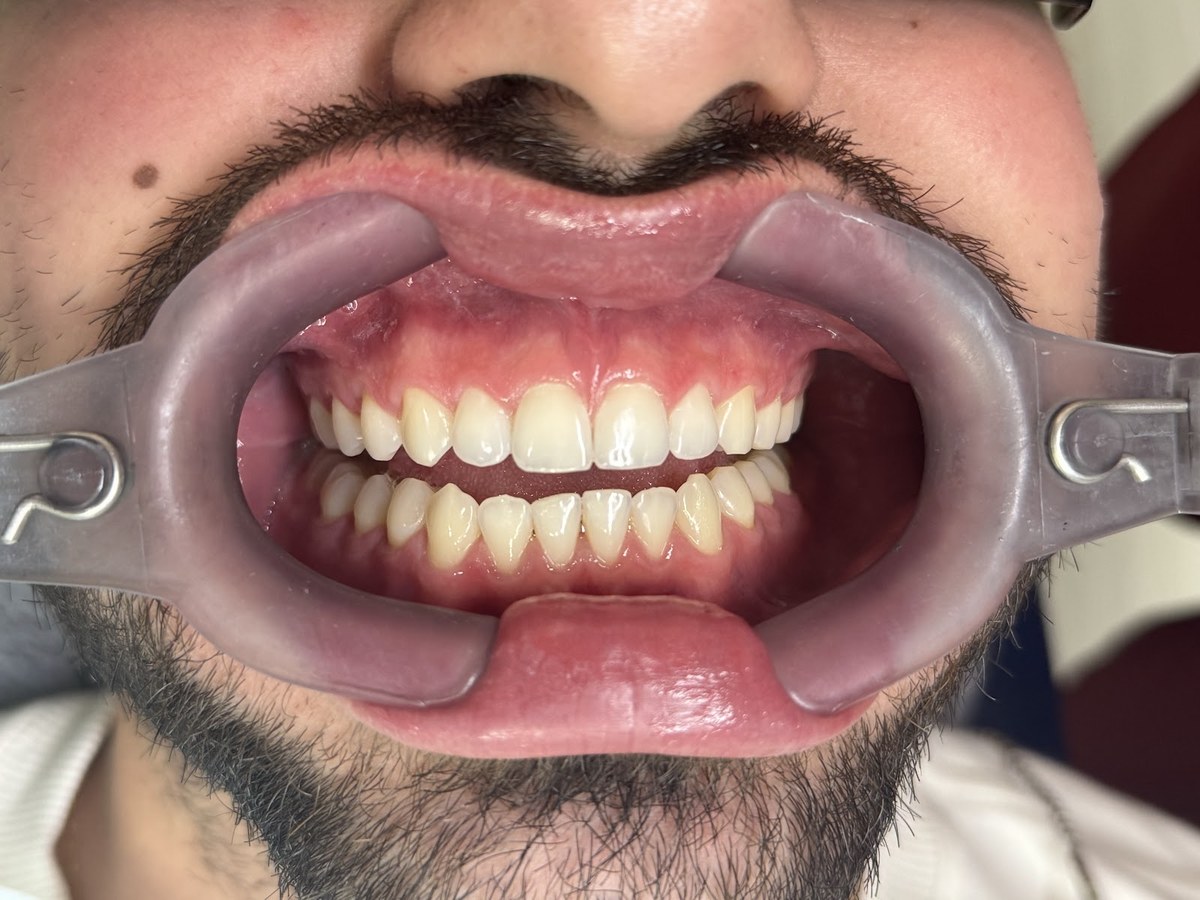 Antes do tratamento: Evolução da cor dos dentes com clareamento