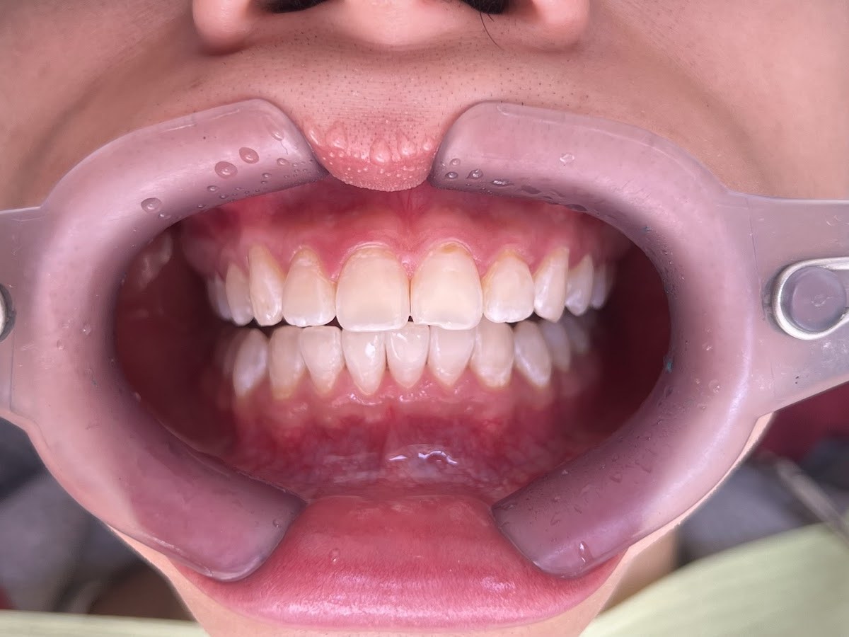 Depois do tratamento: Clareamento para uniformizar a cor do sorriso