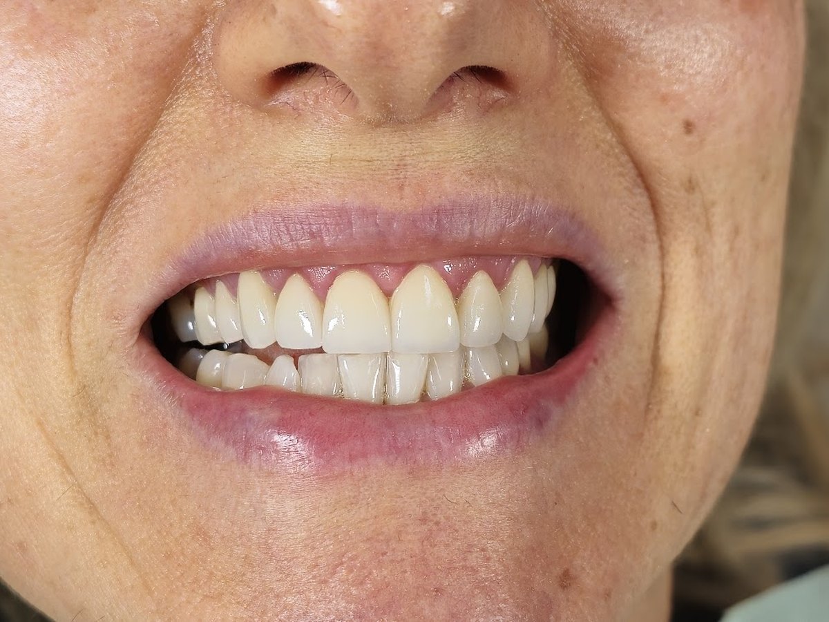 Depois do tratamento: Renovação estética do sorriso