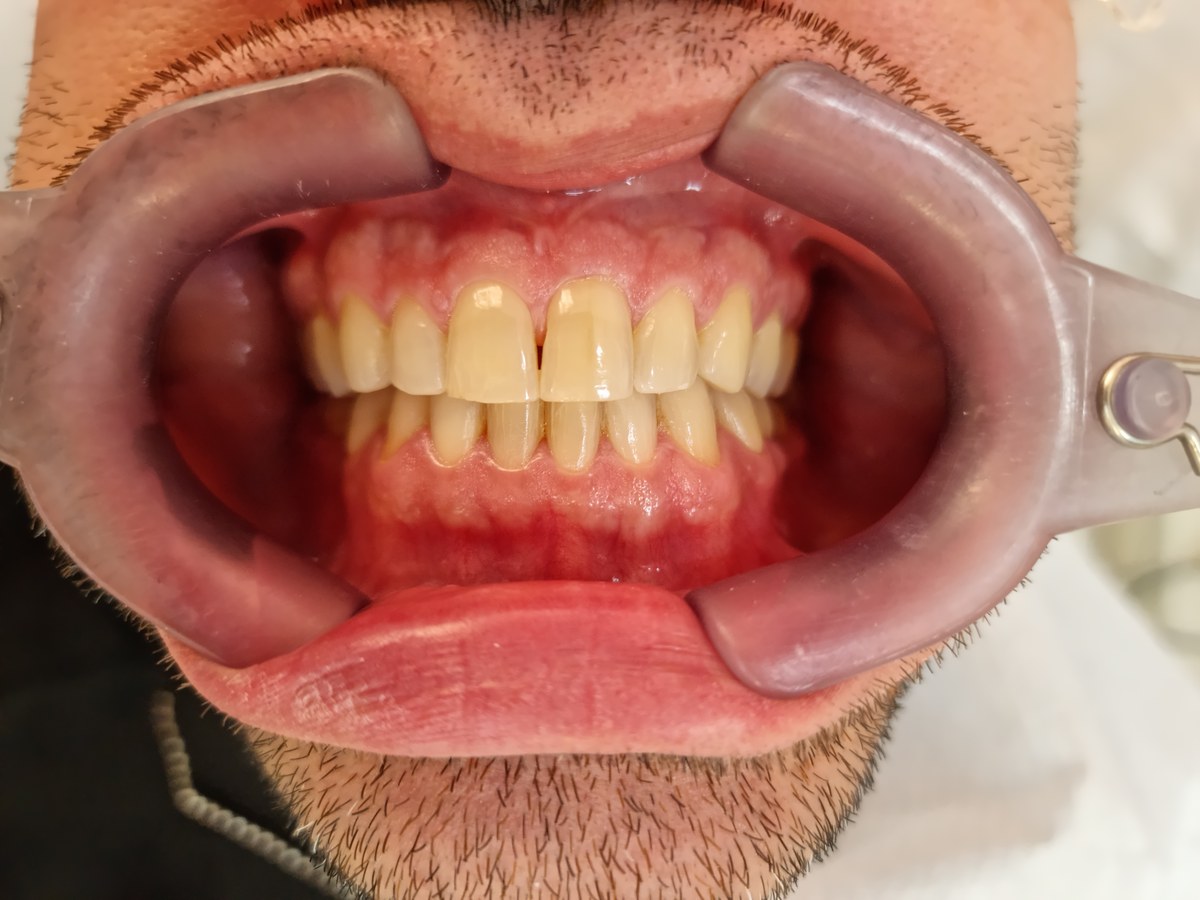 Antes do tratamento: Clareamento para um sorriso mais luminoso