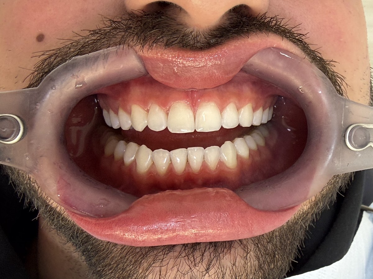 Depois do tratamento: Evolução da cor dos dentes com clareamento