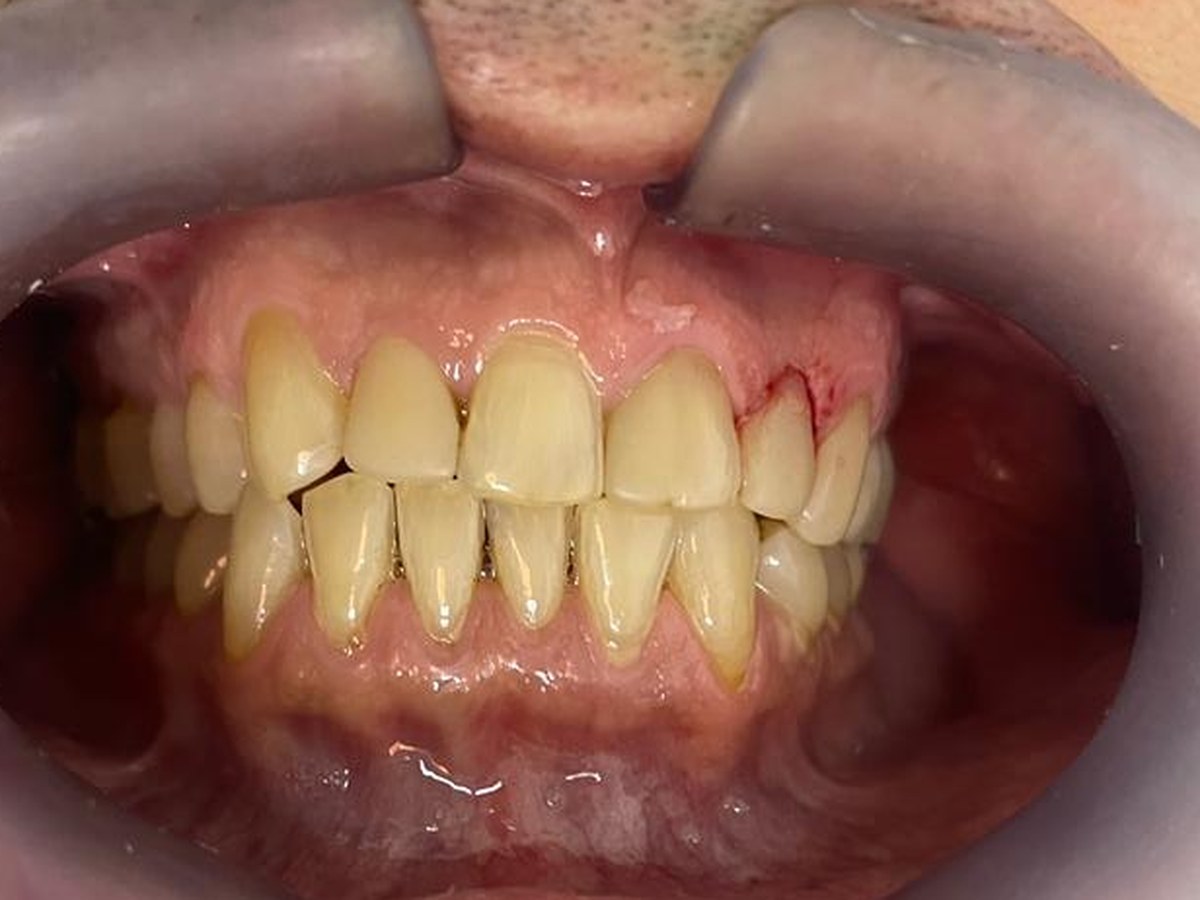 Antes do tratamento: Lentes de contato para um sorriso mais claro e harmônico