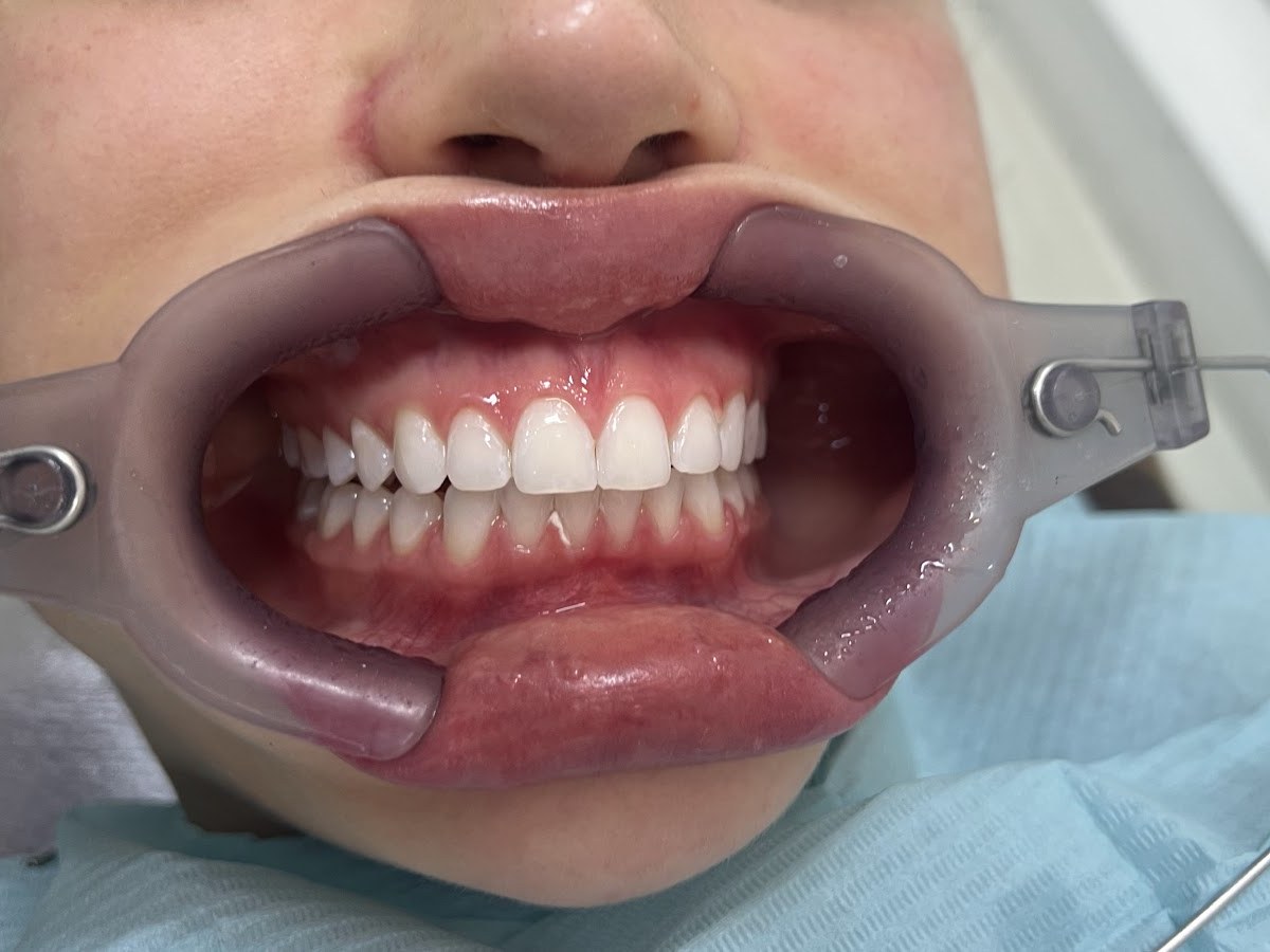 Depois do tratamento: Clareamento dental com acompanhamento clínico