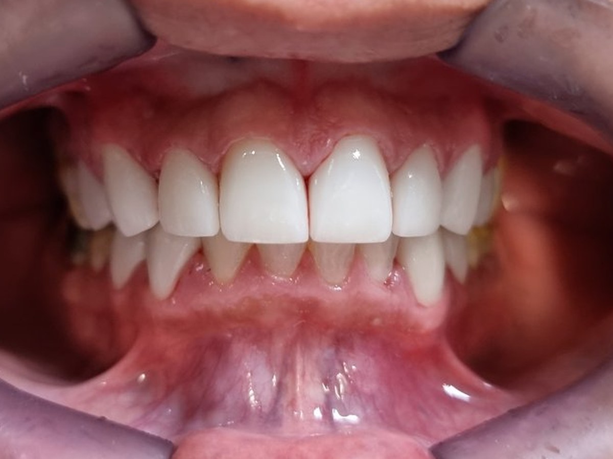 Depois do tratamento: Transformação estética dos dentes anteriores
