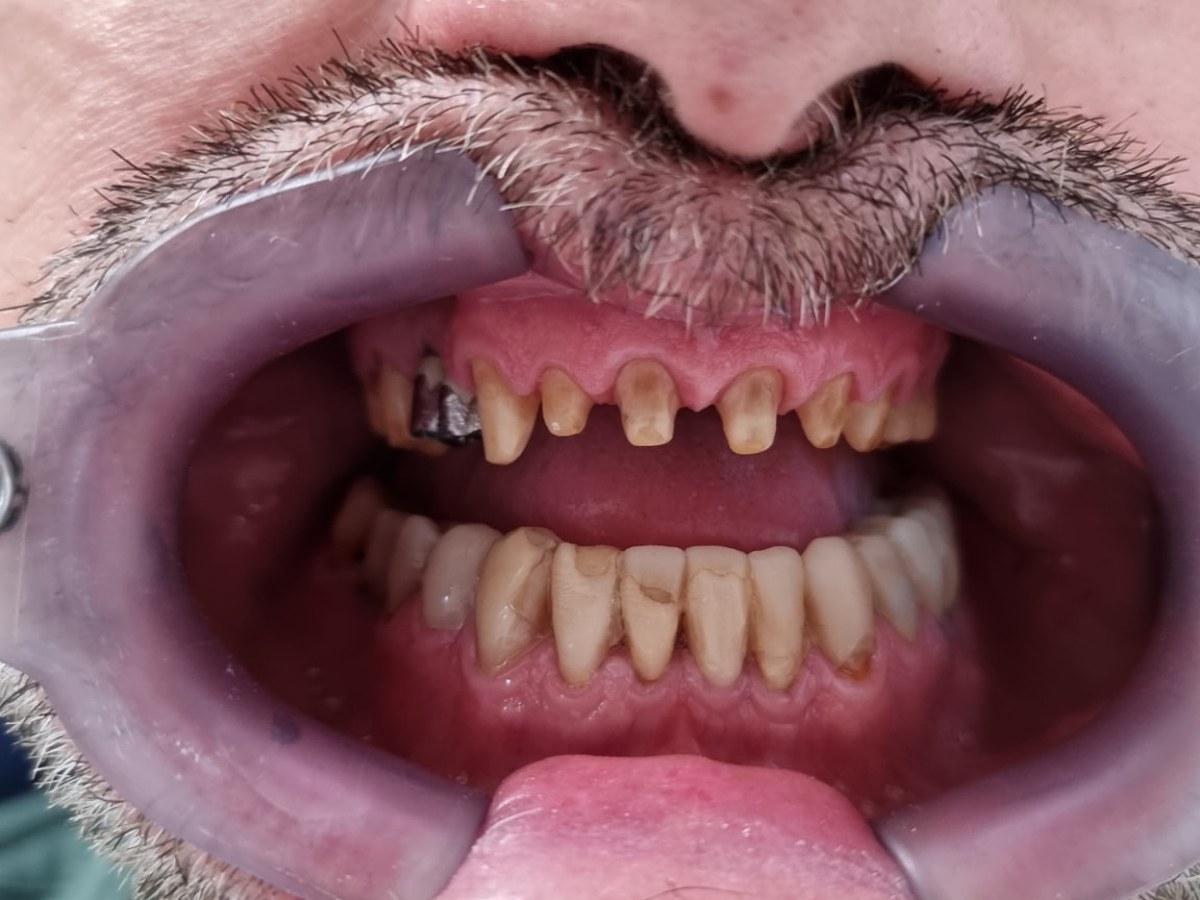 Antes do tratamento: Reabilitação oral completa do sorriso