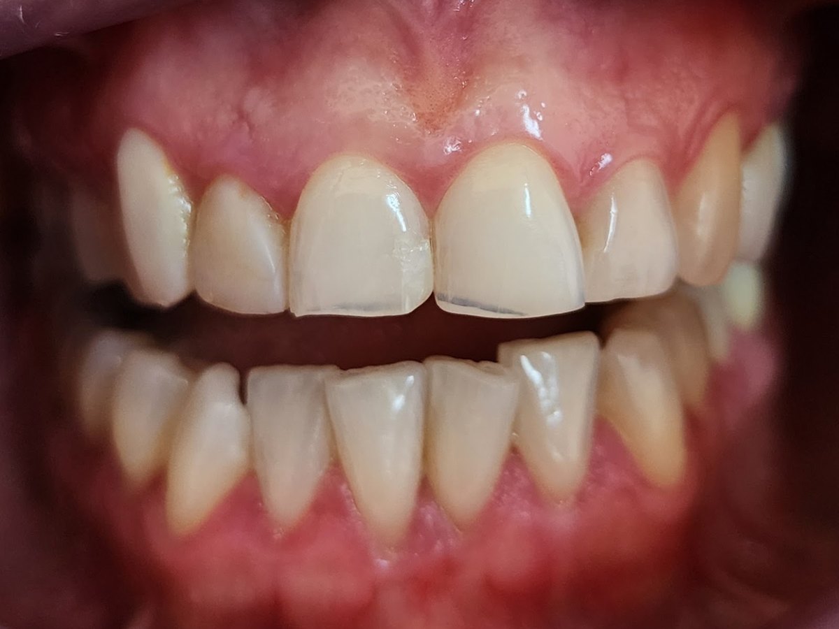Antes do tratamento: Renovação estética do sorriso