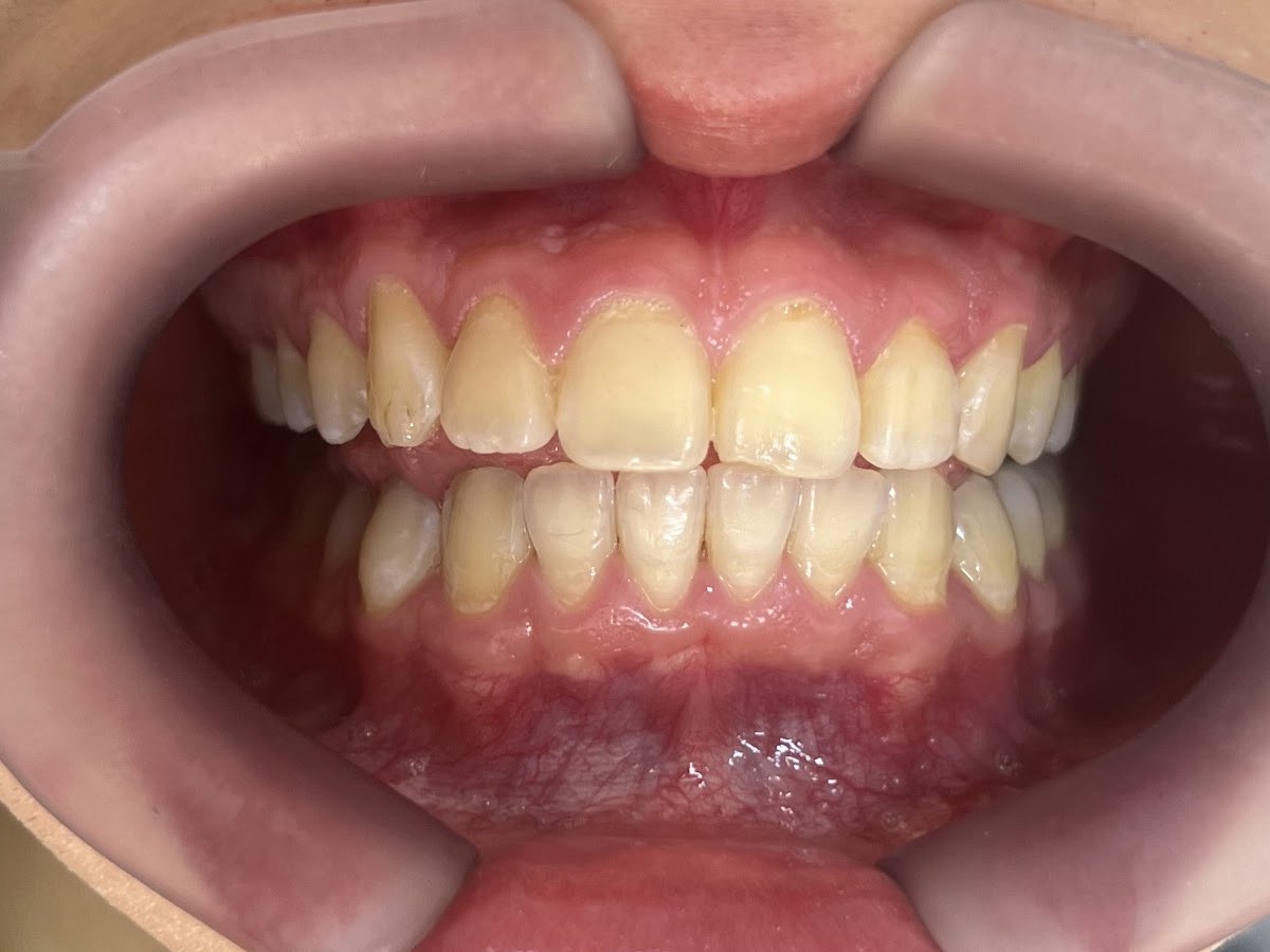 Antes do tratamento: Clareamento para uniformizar a cor do sorriso