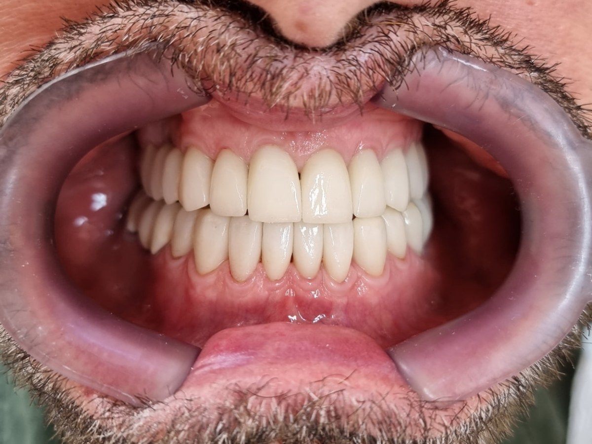 Depois do tratamento: Reabilitação oral completa do sorriso