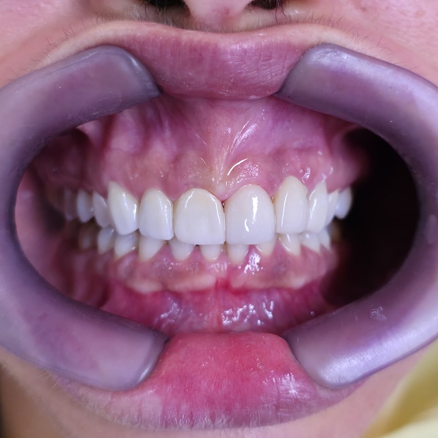 Depois do tratamento: Comparação do sorriso da paciente