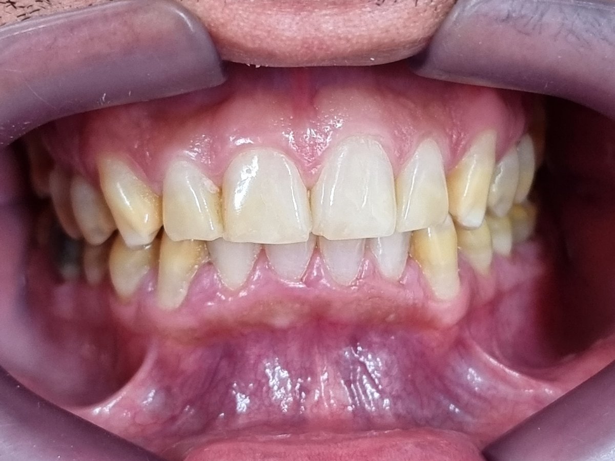 Antes do tratamento: Transformação estética dos dentes anteriores