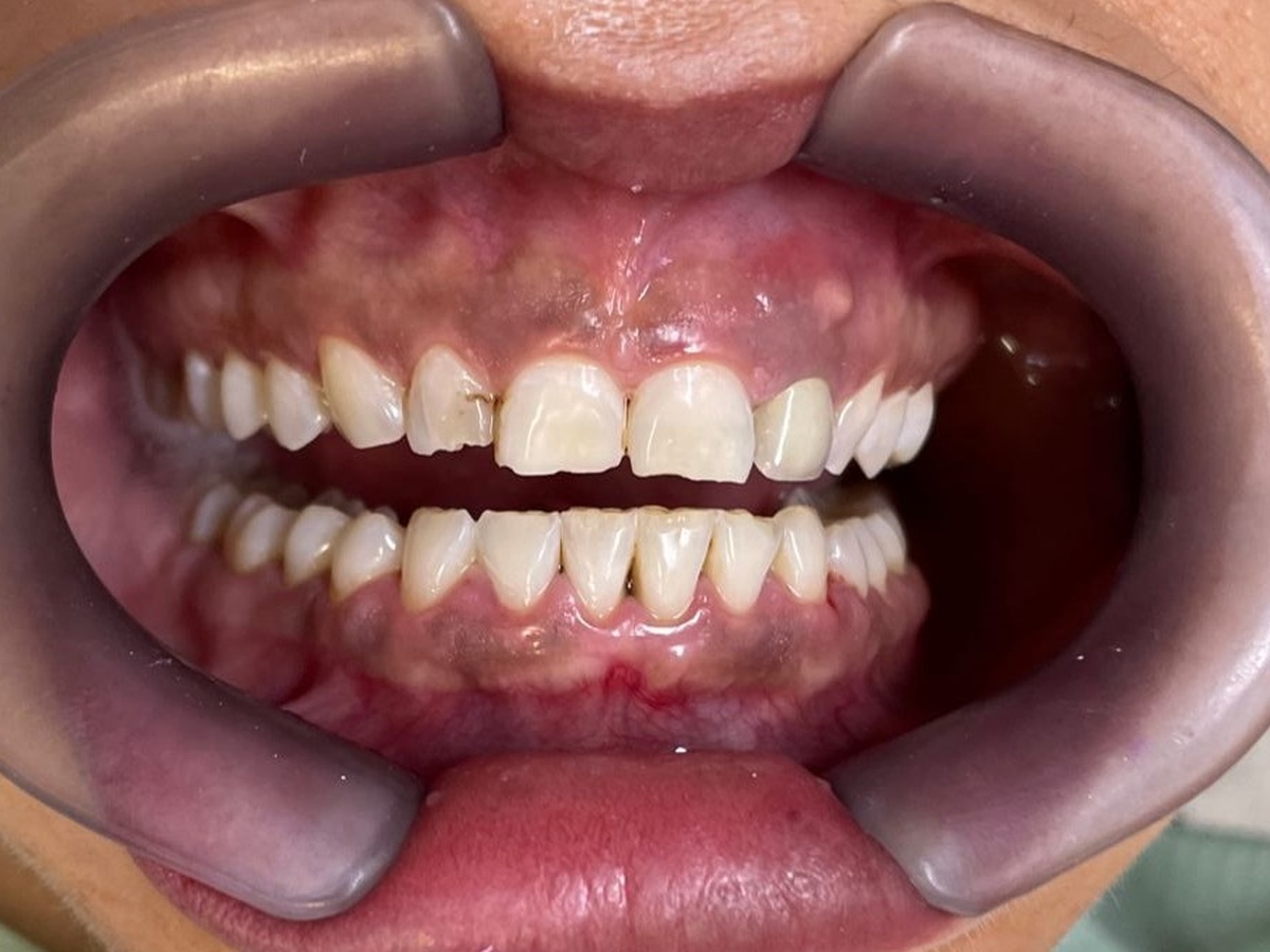 Antes do tratamento: Comparação do sorriso da paciente
