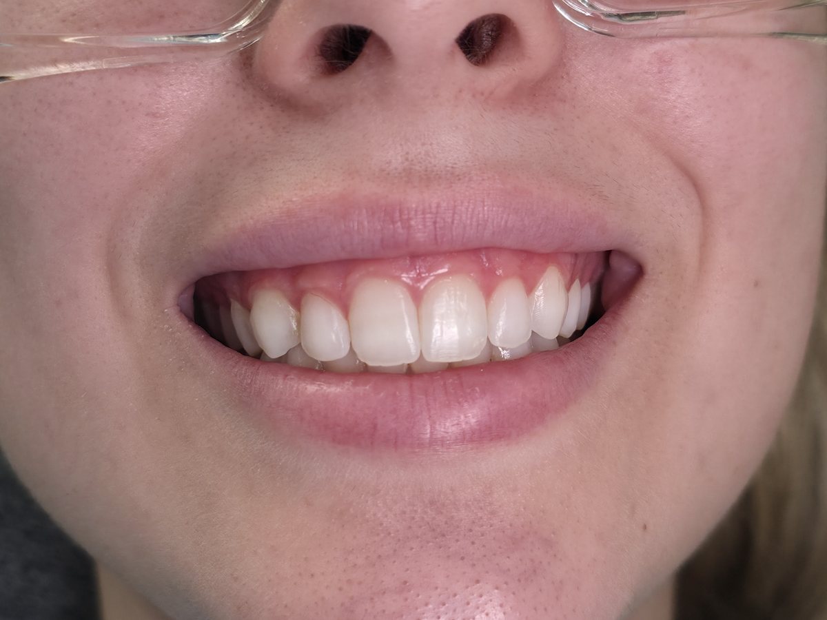 Antes do tratamento: Plástica gengival para harmonizar o sorriso