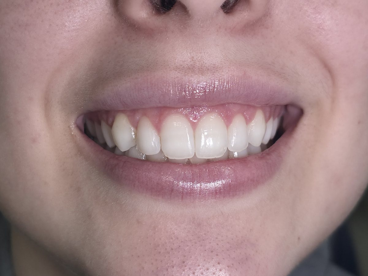 Depois do tratamento: Plástica gengival para harmonizar o sorriso