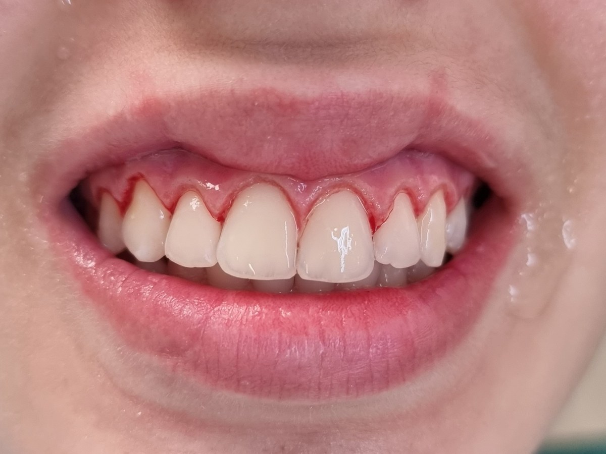 Depois do tratamento: Gengivoplastia para valorizar o contorno dos dentes