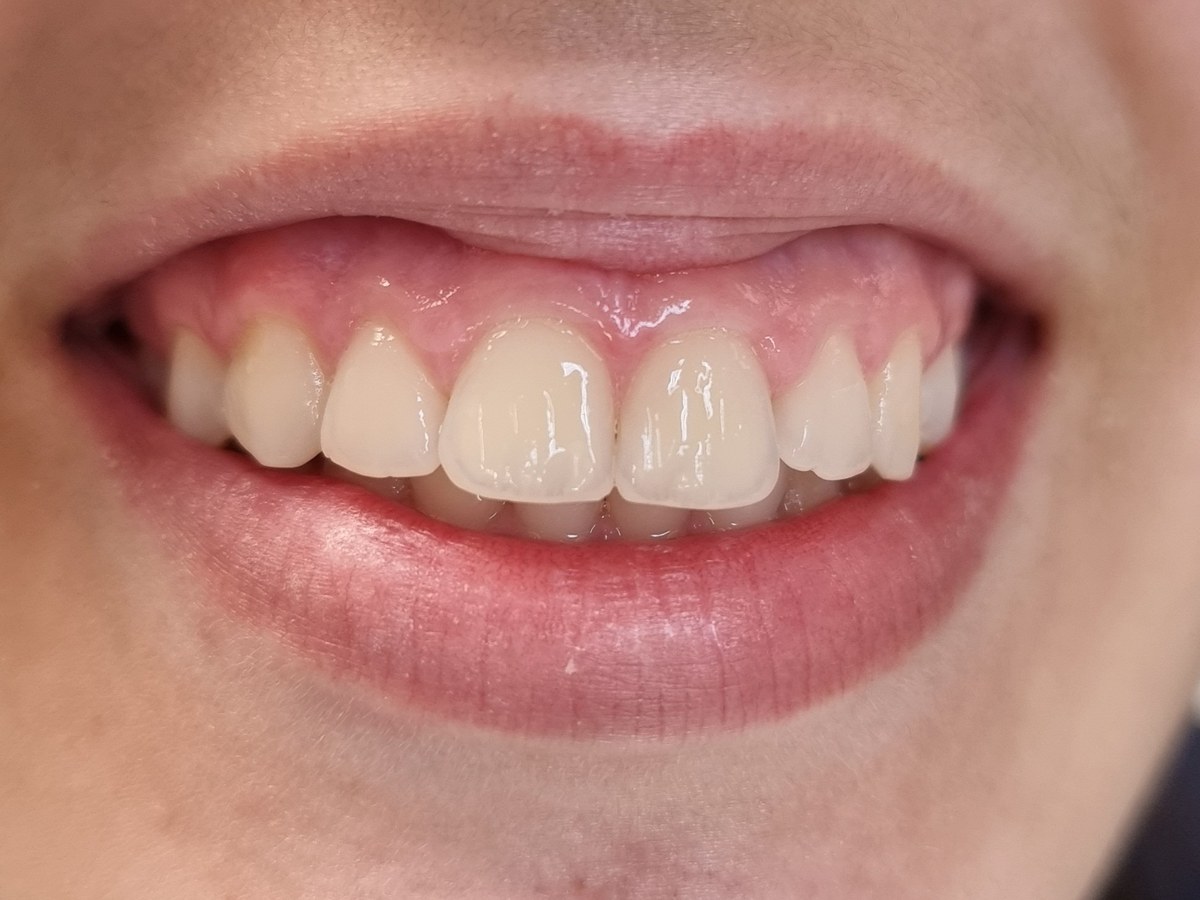 Antes do tratamento: Gengivoplastia para valorizar o contorno dos dentes