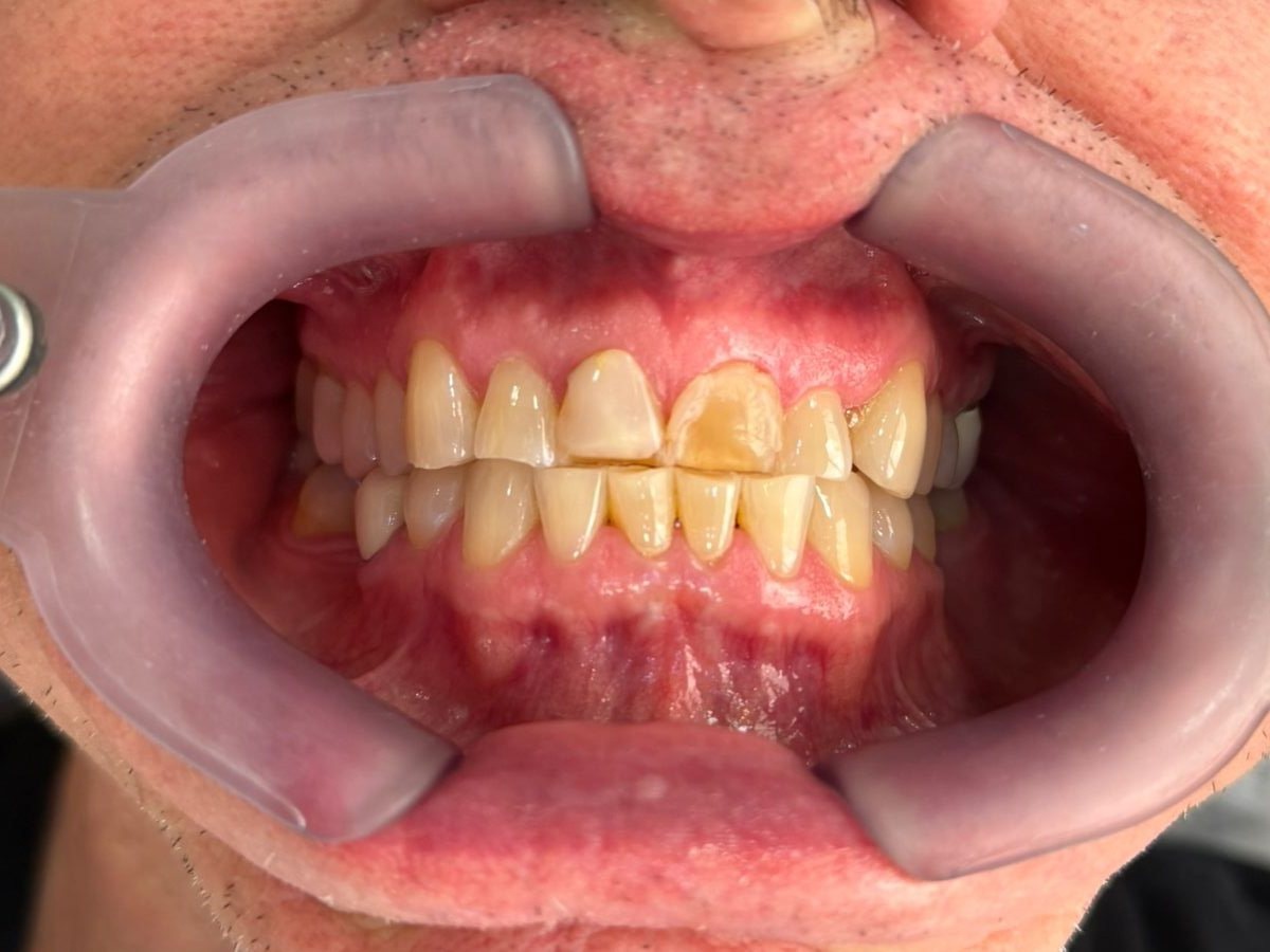 Antes do tratamento: Lentes de contato em porcelana nos dentes superiores