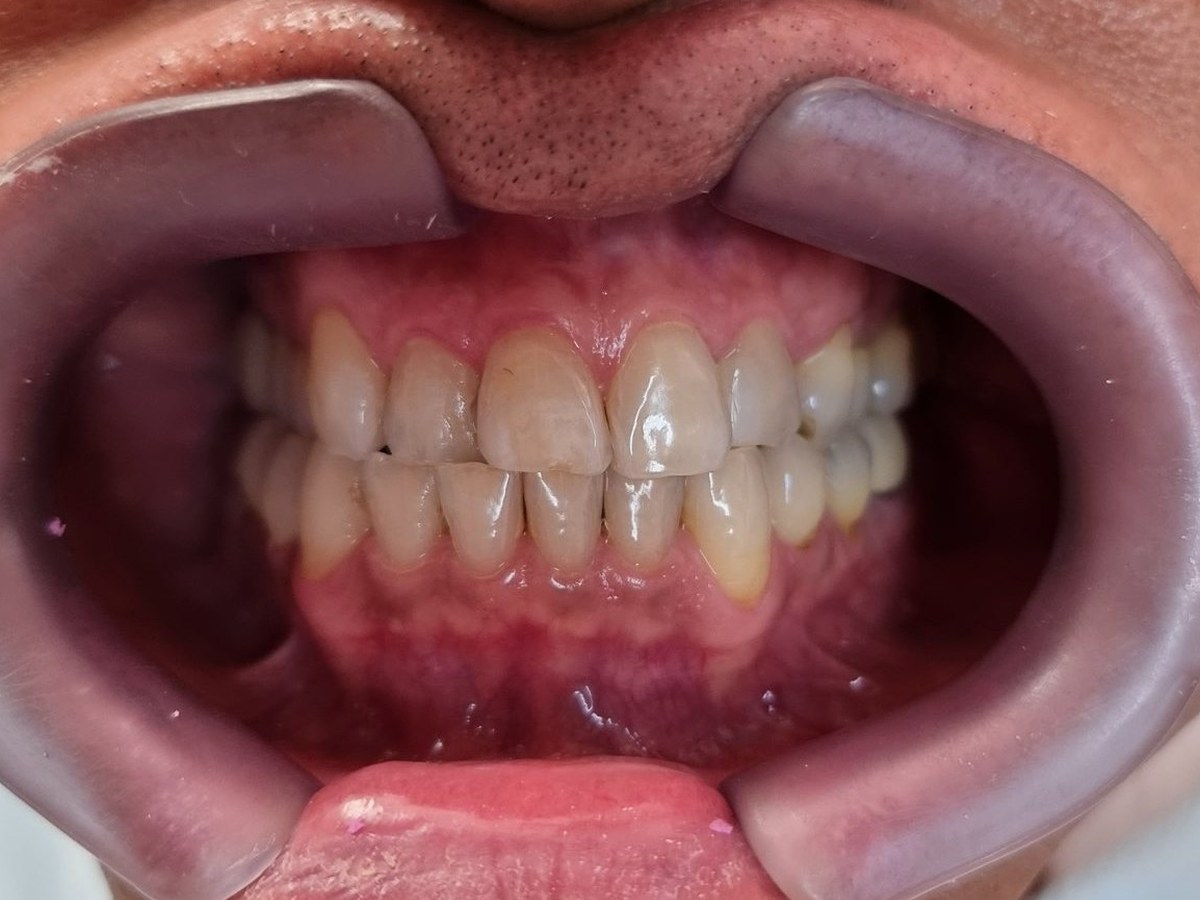 Antes do tratamento: Reconstrução estética do sorriso com lentes de contato