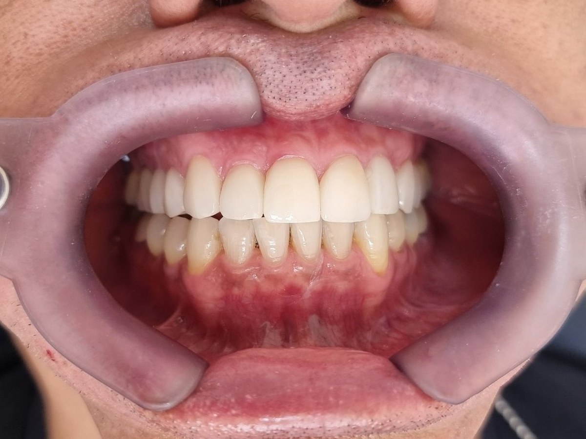 Depois do tratamento: Reconstrução estética do sorriso com lentes de contato
