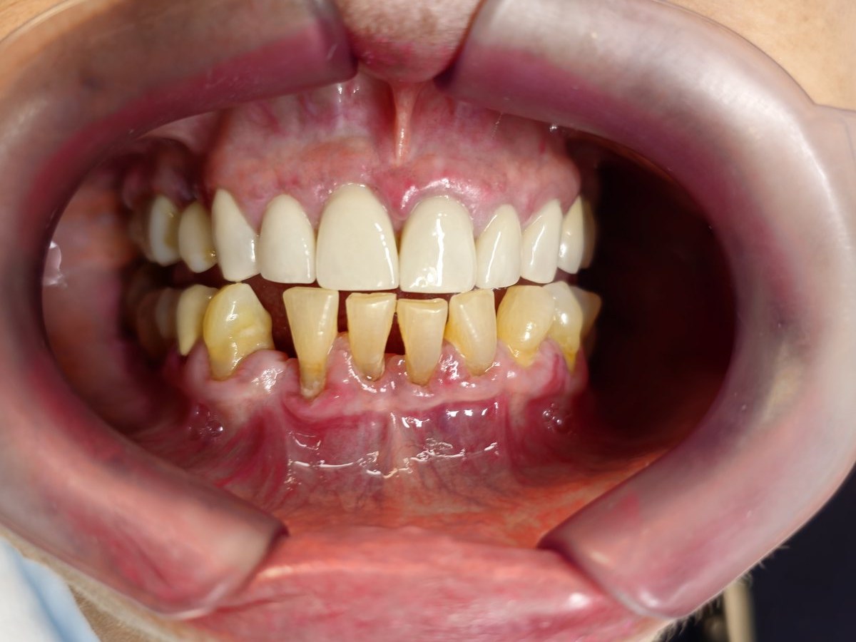 Antes do tratamento: Troca de restaurações antigas por facetas de porcelana