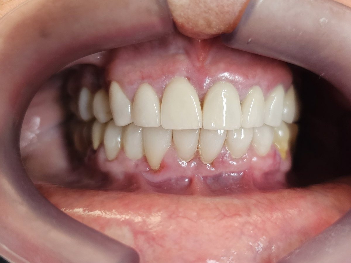 Depois do tratamento: Troca de restaurações antigas por facetas de porcelana