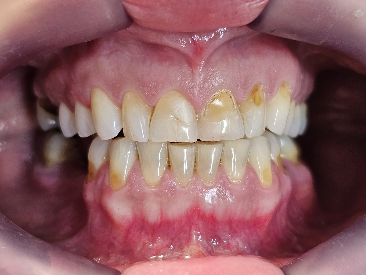 Antes do tratamento: Harmonia de cor e formato nos dentes superiores