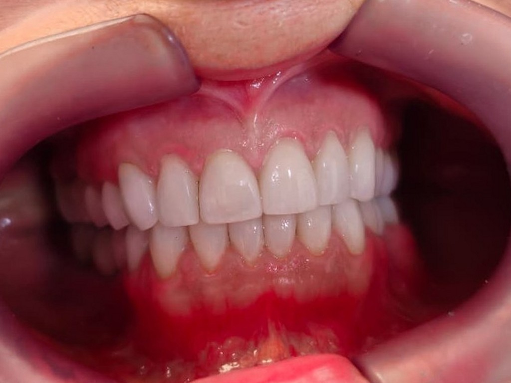 Depois do tratamento: Harmonia de cor e formato nos dentes superiores